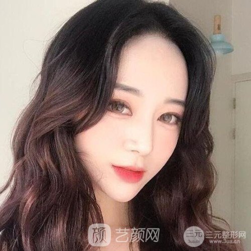 上海華美楊亞益主任做的芭比雙眼皮，果很好哦~